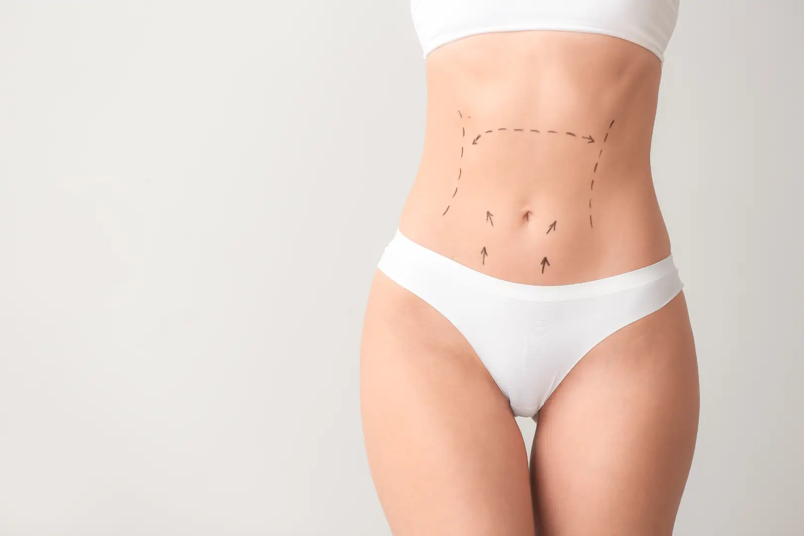Abdominal Surgical Markings Case #12761 - Pancholi Cosmetic Surgery