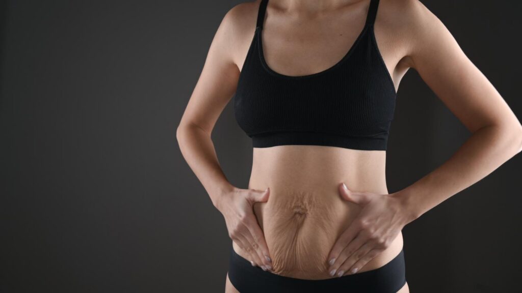 Loose Abdominal Skin Case #12715 - Pancholi Cosmetic Surgery