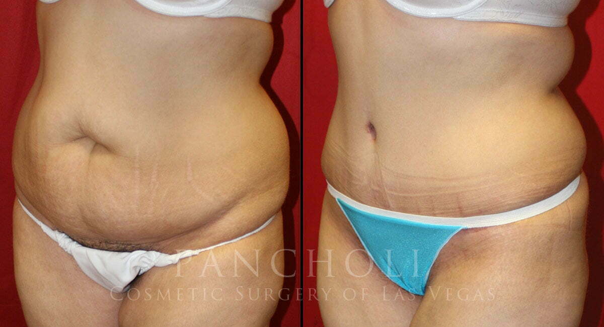 Tummy Tuck Surgery (Abdominoplasty)