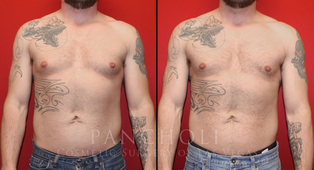 Male Breast Reduction 7198 - Cosmetic Surgery of Las Vegas
