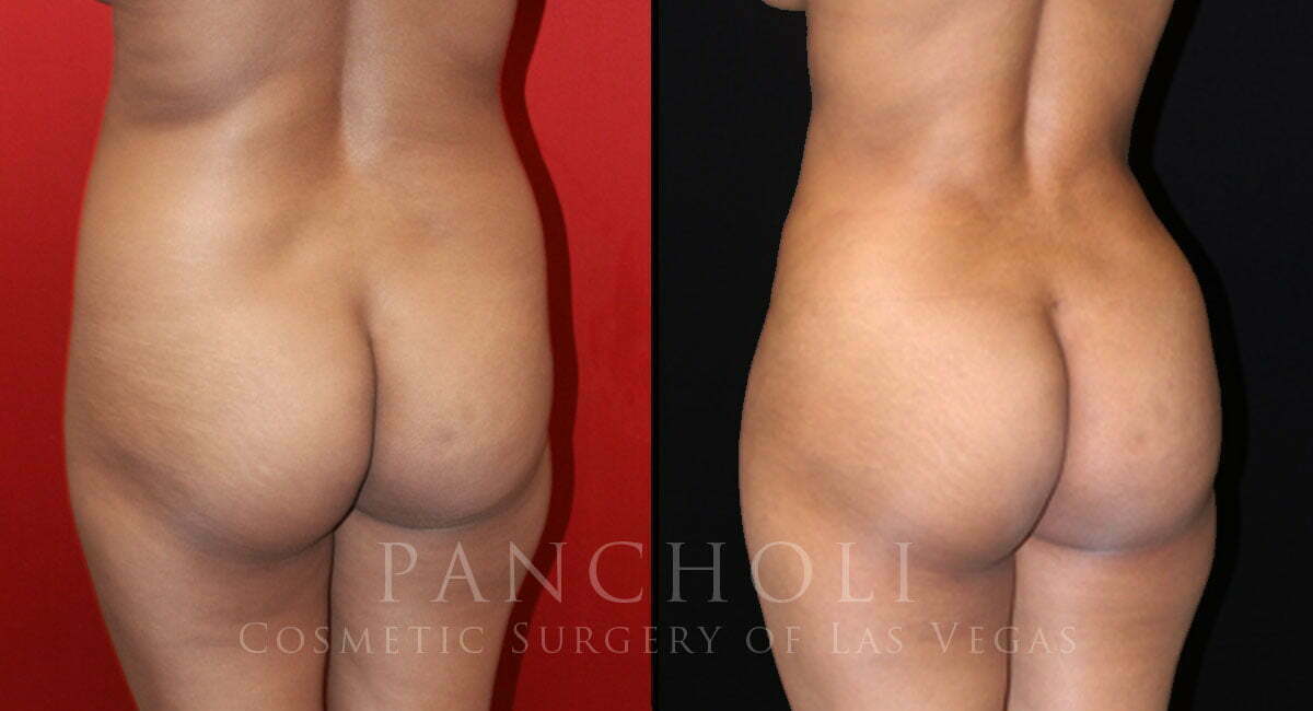 Liposuction