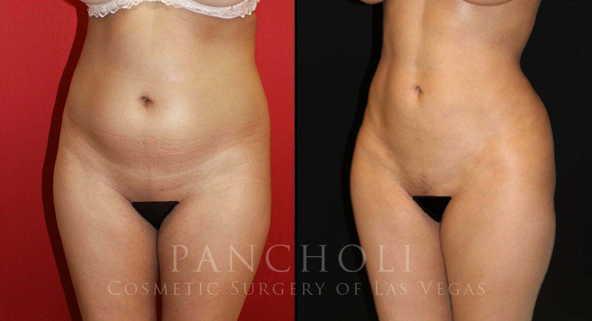 Liposuction