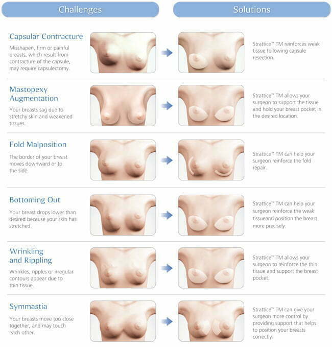 How to perform breast augmentation using a composite myofascial