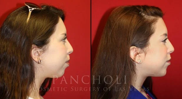 Chin Enhancement Before and After Gallery