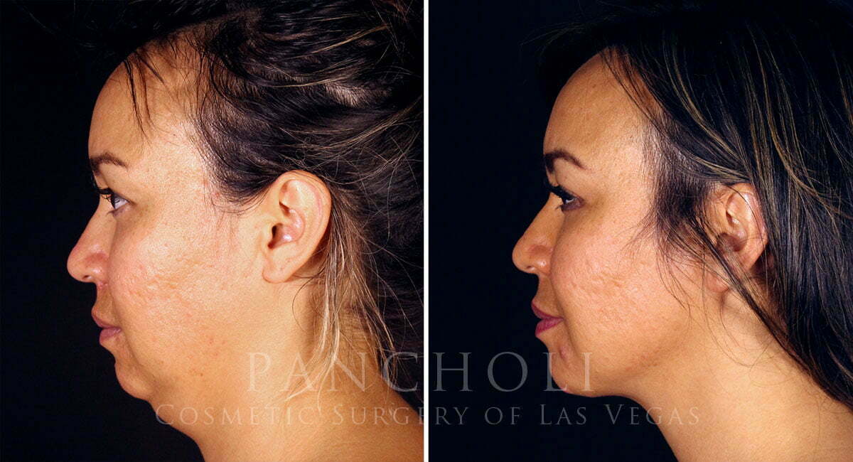 Submentoplasty Mini Neck Lift Double Chin Surgery Dr Samir Pancholi 4075