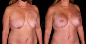 Breast Lift With Implants Before After Photos Case #8132 - Pancholi Cosmetic Surgery