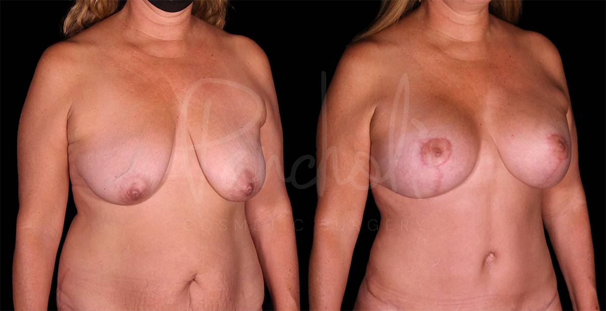 Breast Lift With Implants Before After Photos Case #8132 - Pancholi Cosmetic Surgery