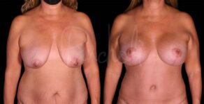 Breast Lift With Implants Before After Photos Case #8133 - Pancholi Cosmetic Surgery