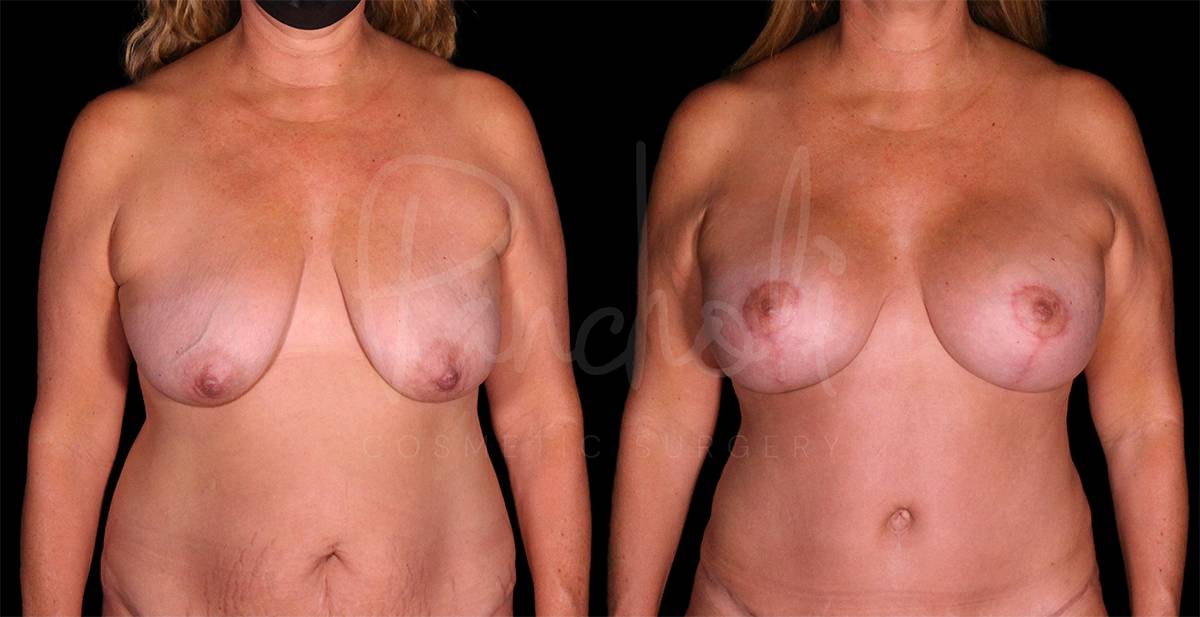 Breast Lift With Implants Before After Photos Case #8133 - Pancholi Cosmetic Surgery