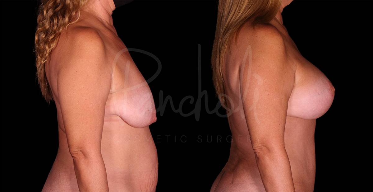 Breast Lift With Implants Before After Photos Case #8134 - Pancholi Cosmetic Surgery