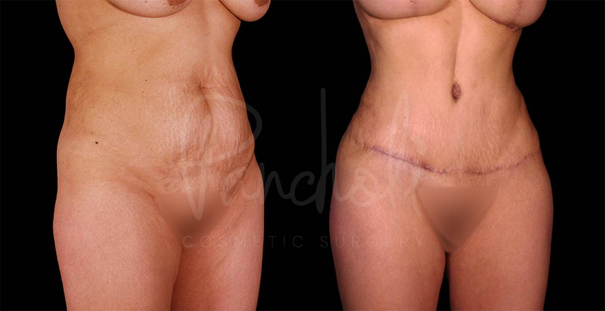 Liposuction Before After Photos Tummy Tuck Before And After Real Results From Las Vegas Patients Case #8073 - Pancholi Cosmetic Surgery