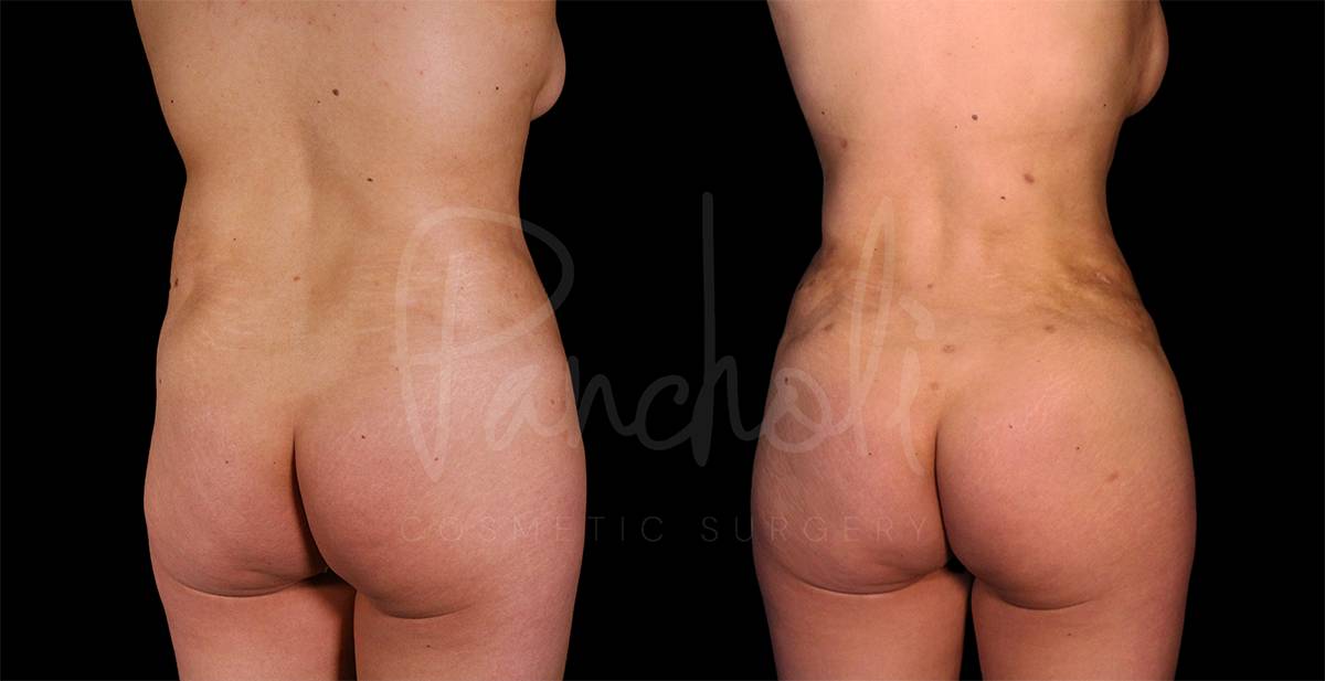 Liposuction Before After Photos Tummy Tuck Before And After Real Results From Las Vegas Patients Case #8074 - Pancholi Cosmetic Surgery
