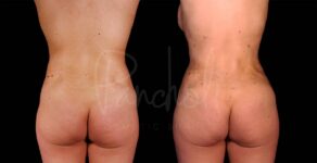 Liposuction Before After Photos Tummy Tuck Before And After Real Results From Las Vegas Patients Case #8075 - Pancholi Cosmetic Surgery