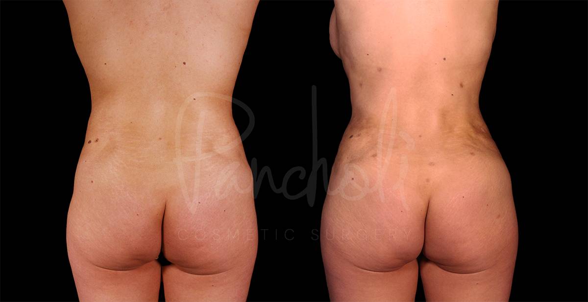 Liposuction Before After Photos Tummy Tuck Before And After Real Results From Las Vegas Patients Case #8075 - Pancholi Cosmetic Surgery