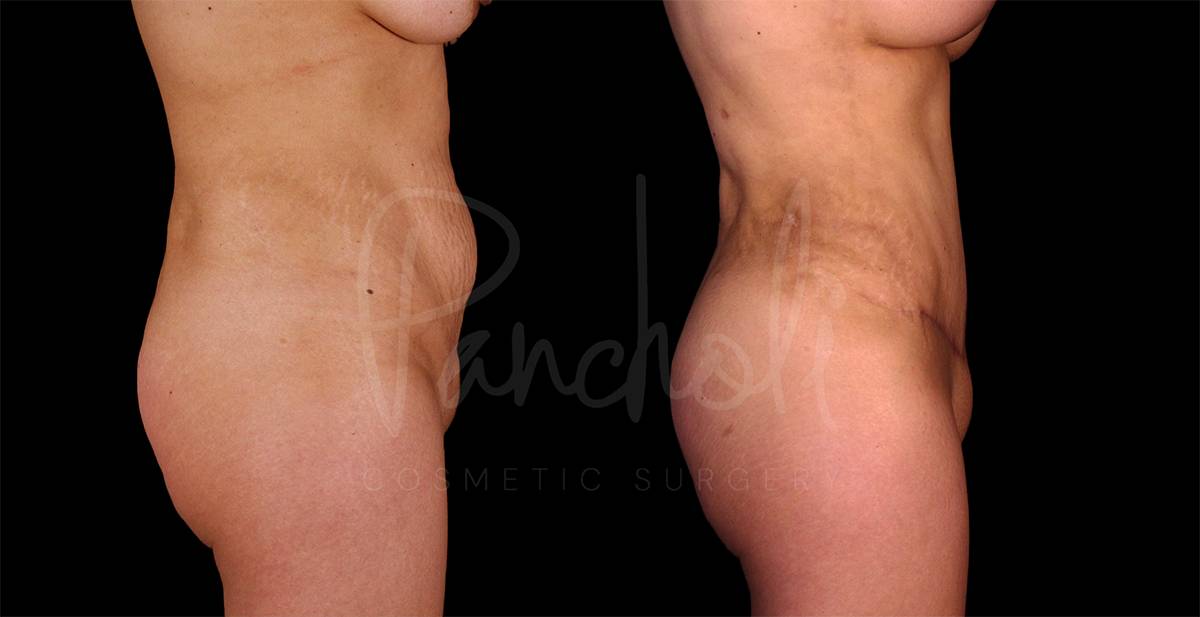 Liposuction Before After Photos Tummy Tuck Before And After Real Results From Las Vegas Patients Case #8077 - Pancholi Cosmetic Surgery