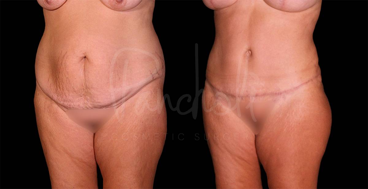 Liposuction Before After Photos Tummy Tuck Before And After Real Results From Las Vegas Patients Case #8126 - Pancholi Cosmetic Surgery
