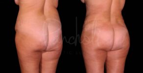 Liposuction Before After Photos Tummy Tuck Before And After Real Results From Las Vegas Patients Case #8127 - Pancholi Cosmetic Surgery
