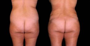 Liposuction Before After Photos Tummy Tuck Before And After Real Results From Las Vegas Patients Case #8128 - Pancholi Cosmetic Surgery