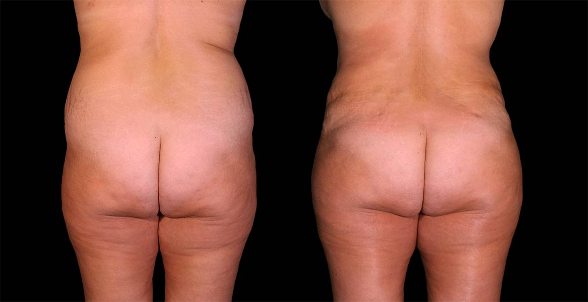 Liposuction Before After Photos Tummy Tuck Before And After Real Results From Las Vegas Patients Case #8128 - Pancholi Cosmetic Surgery