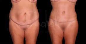 Liposuction Before After Photos Tummy Tuck Before And After Real Results From Las Vegas Patients Case #8129 - Pancholi Cosmetic Surgery