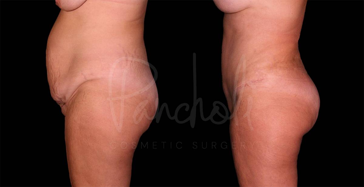 Liposuction Before After Photos Tummy Tuck Before And After Real Results From Las Vegas Patients Case #8130 - Pancholi Cosmetic Surgery