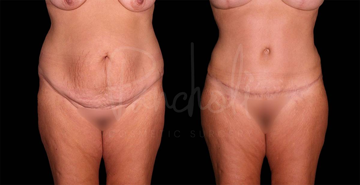 Tummy Tuck Before And After Real Results From Las Vegas Patients Case #8123 - Pancholi Cosmetic Surgery