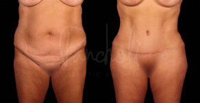 Liposuction Before After Photos Tummy Tuck Before And After Real Results From Las Vegas Patients Bbl Before After Photos Case #9331 - Pancholi Cosmetic Surgery