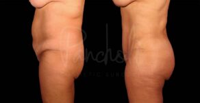 Liposuction Before After Photos Tummy Tuck Before And After Real Results From Las Vegas Patients Bbl Before After Photos Case #9332 - Pancholi Cosmetic Surgery