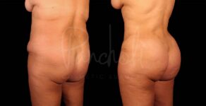 Liposuction Before After Photos Tummy Tuck Before And After Real Results From Las Vegas Patients Bbl Before After Photos Case #9334 - Pancholi Cosmetic Surgery