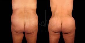Liposuction Before After Photos Tummy Tuck Before And After Real Results From Las Vegas Patients Bbl Before After Photos Case #9335 - Pancholi Cosmetic Surgery