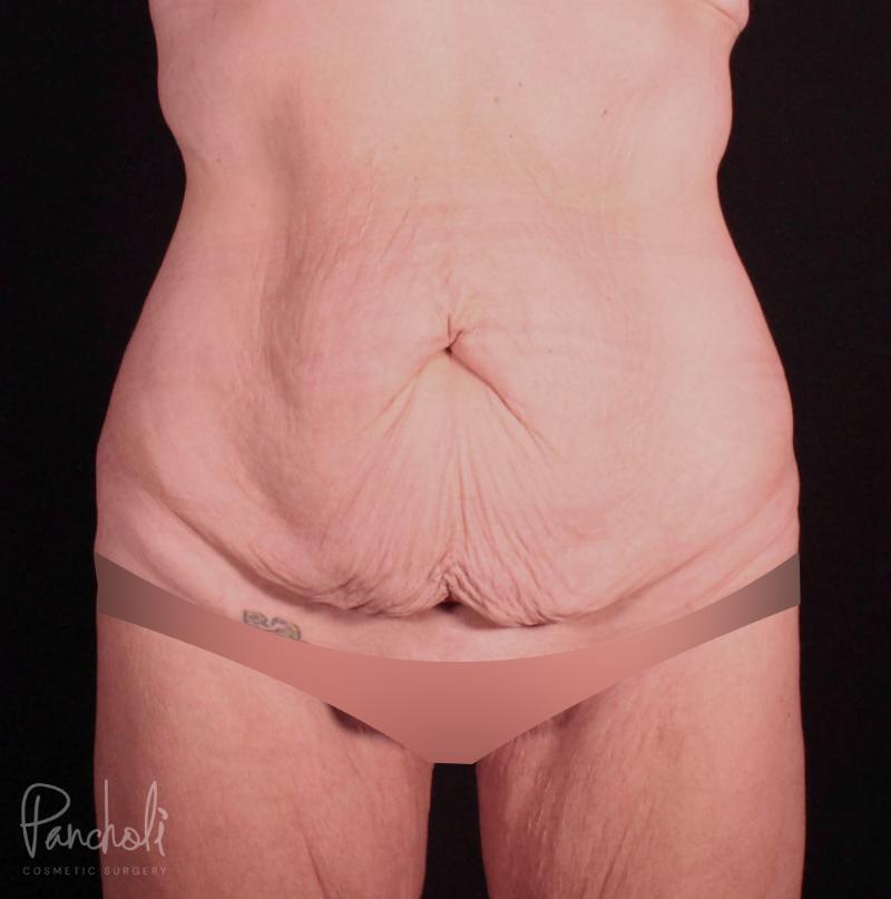 Belt Lipectomy Case #12232 - Pancholi Cosmetic Surgery