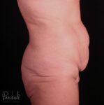 Belt Lipectomy Case #12234 - Pancholi Cosmetic Surgery