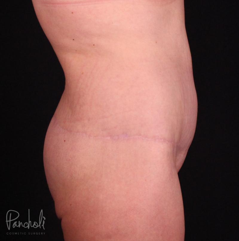 Belt Lipectomy Case #12235 - Pancholi Cosmetic Surgery