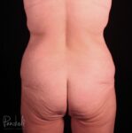 Belt Lipectomy Case #12236 - Pancholi Cosmetic Surgery