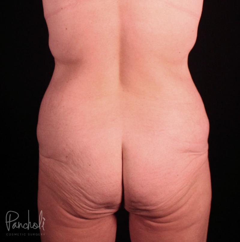 Belt Lipectomy Case #12236 - Pancholi Cosmetic Surgery