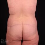 Belt Lipectomy Case #12237 - Pancholi Cosmetic Surgery