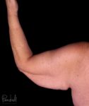 Brachioplasty Before After Photos Case #12240 - Pancholi Cosmetic Surgery