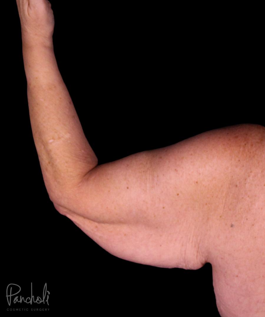 Brachioplasty Before After Photos Case #12240 - Pancholi Cosmetic Surgery