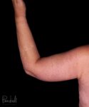 Brachioplasty Before After Photos Case #12241 - Pancholi Cosmetic Surgery