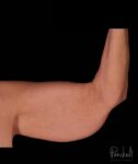 Brachioplasty Before After Photos Case #12253 - Pancholi Cosmetic Surgery