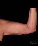 Brachioplasty Before After Photos Case #12256 - Pancholi Cosmetic Surgery