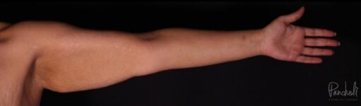 Brachioplasty Before After Photos Case #12294 - Pancholi Cosmetic Surgery