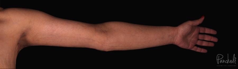 Brachioplasty Before After Photos Case #12295 - Pancholi Cosmetic Surgery