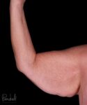Brachioplasty Before After Photos Case #12296 - Pancholi Cosmetic Surgery