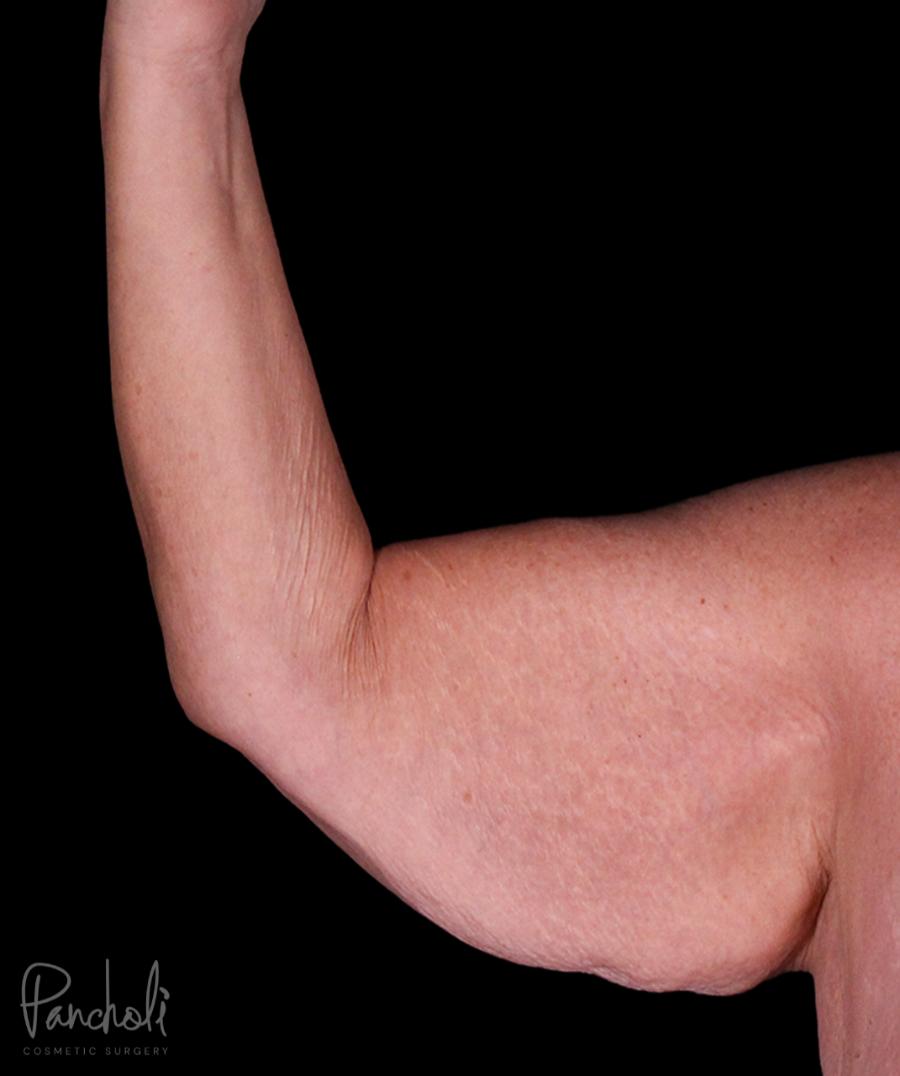 Brachioplasty Before After Photos Case #12296 - Pancholi Cosmetic Surgery