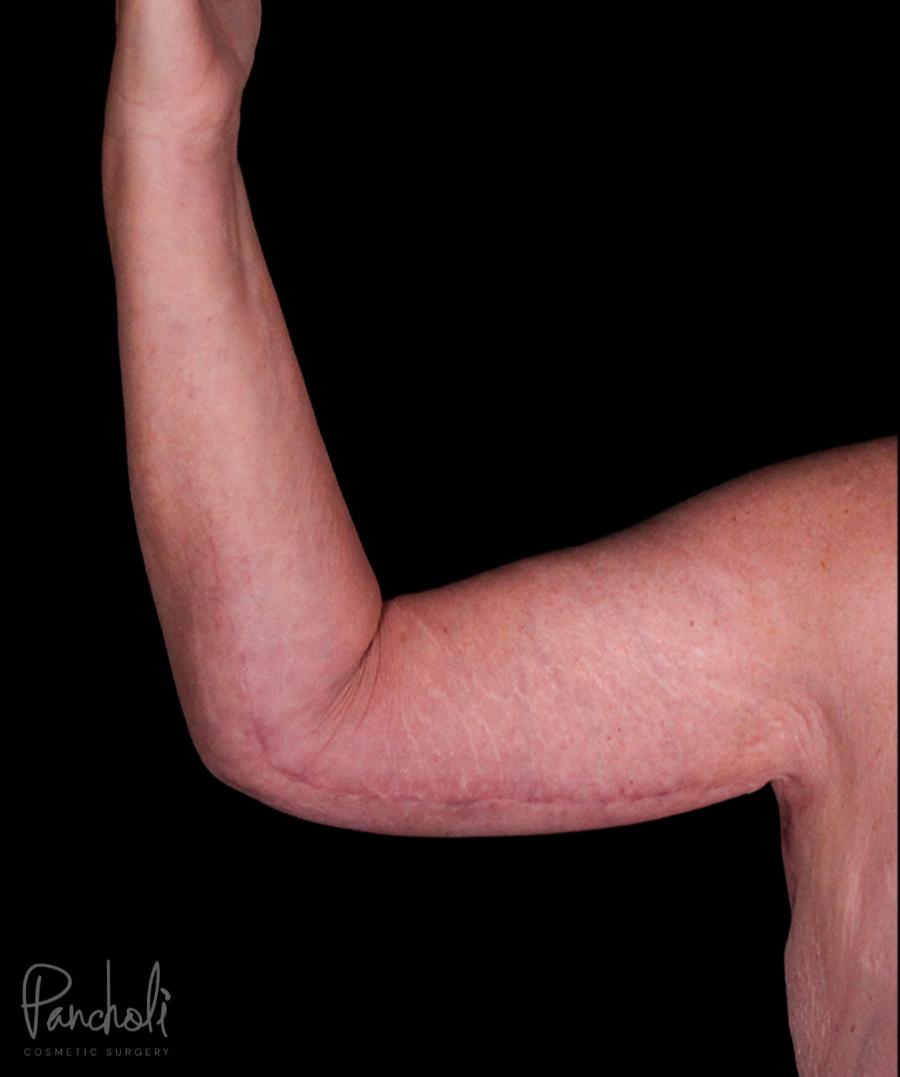 Brachioplasty Before After Photos Case #12297 - Pancholi Cosmetic Surgery