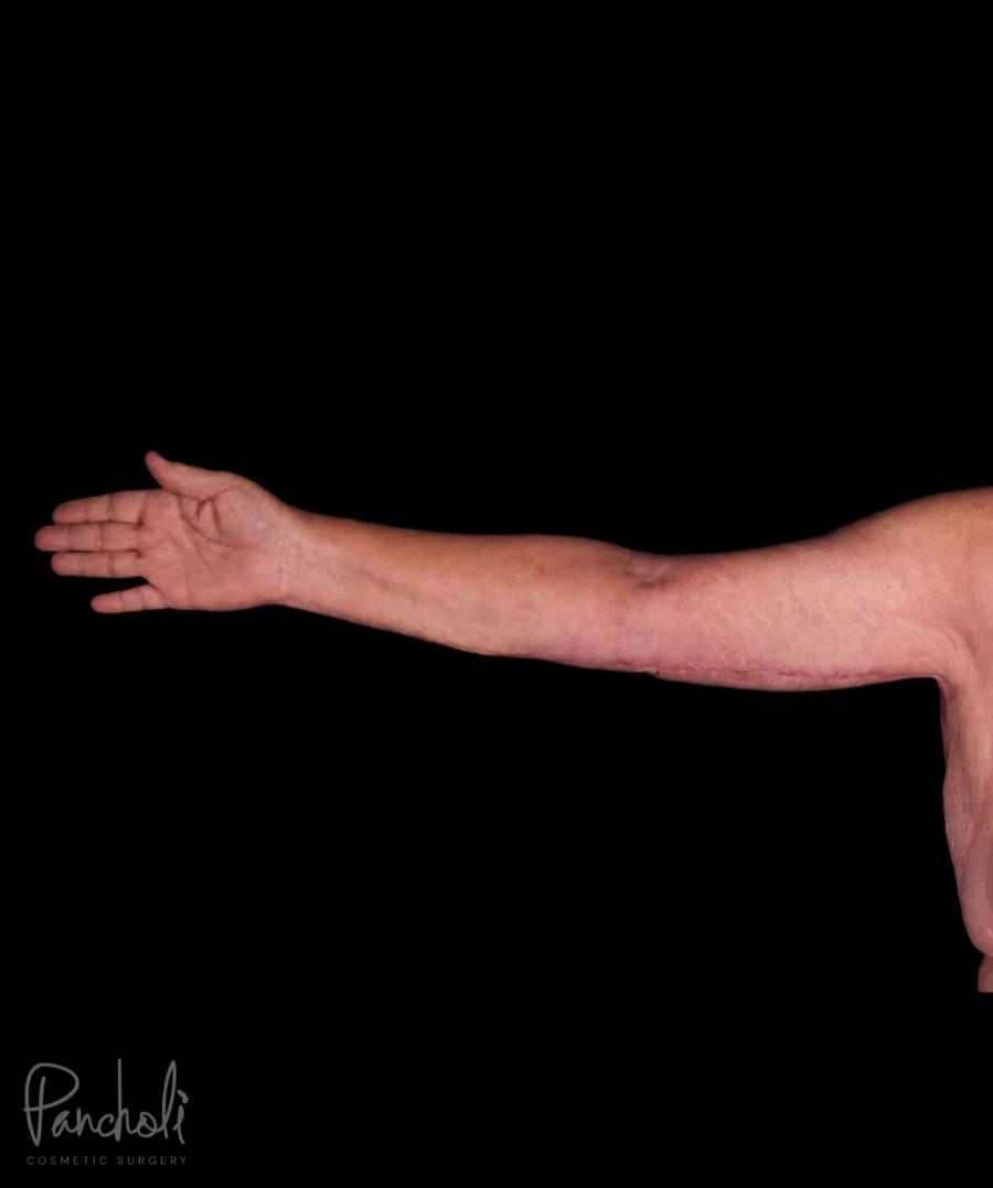 Brachioplasty Before After Photos Case #12299 - Pancholi Cosmetic Surgery