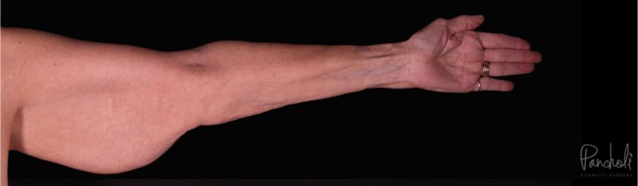 Brachioplasty Before After Photos Case #12300 - Pancholi Cosmetic Surgery