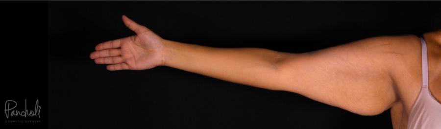 Brachioplasty Before After Photos Case #12303 - Pancholi Cosmetic Surgery