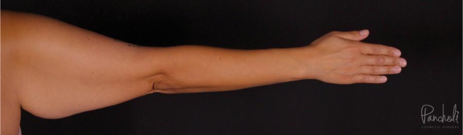 Brachioplasty Before After Photos Case #12305 - Pancholi Cosmetic Surgery